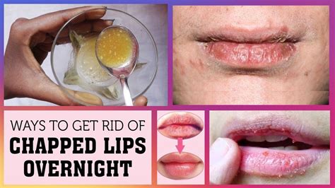 Cure Dry Chapped Lips Overnight 100 Results Overnight Youtube