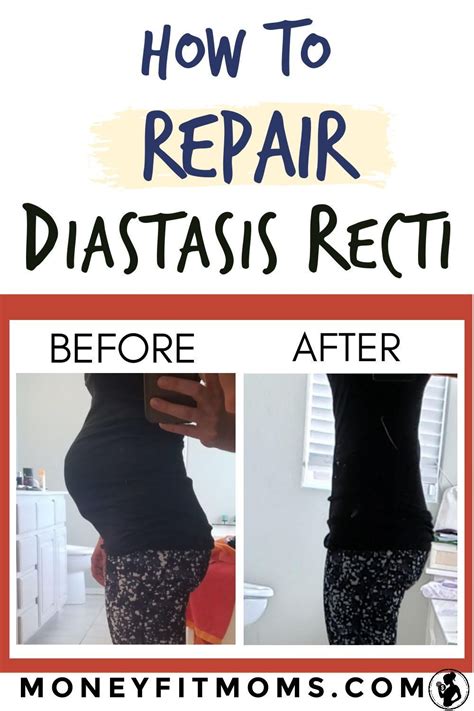 How To Repair Diastasis Recti Surgery Money Fit Moms Diastasis