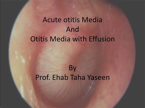 Ppt Acute Otitis Media And Otitis Media With Effusion By Prof Ehab
