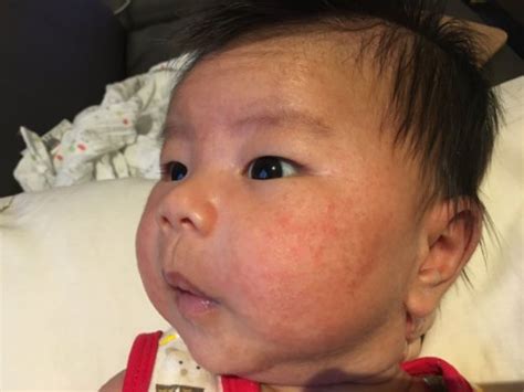 Baby Acne Or Eczema October 2018 Babycenter Australia