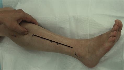 Photograph Of The Skin Incision On The Right Leg Download Scientific