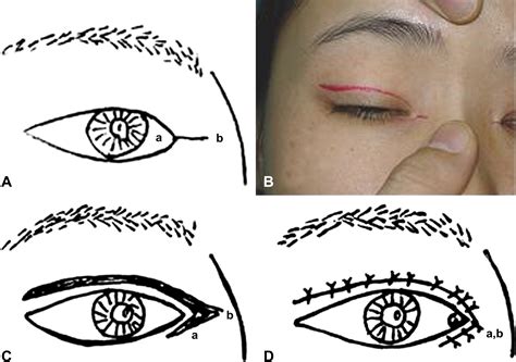 Double Eyelid Blepharoplasty Incorporating Epicanthoplasty Using Y V