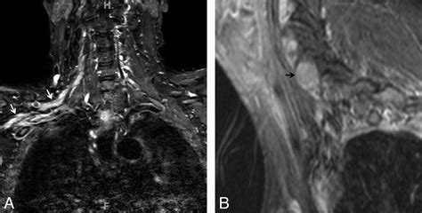 High Resolution Mr Neurography Of Diffuse Peripheral Nerve Lesions