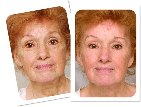 Download Before And After Laser Anti Wrinkle Treatment Collage Full