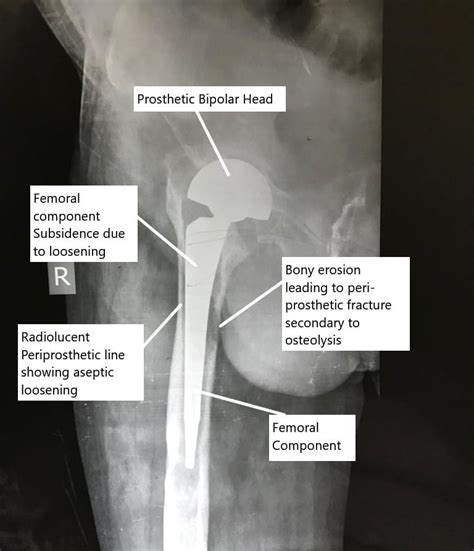Wearing Out Of Total Hip Replacement Surgery Complete Orthopedics