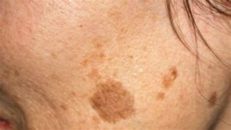 Simple Trick To Remove Brown Spots From Your Skin Youtube