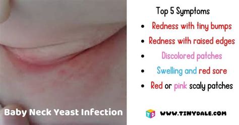 How Can I Treat Baby Neck Yeast Infection