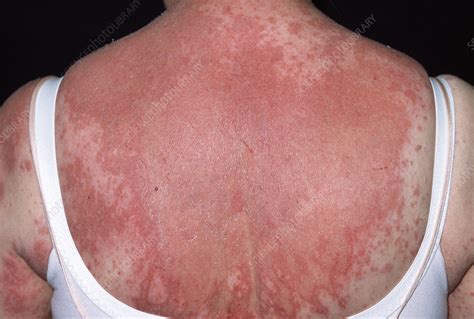 Rash From Drug Allergy Stock Image M3200330 Science Photo Library