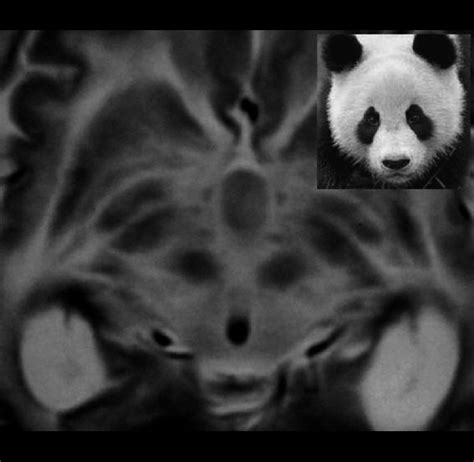 A Giant Panda Face Is Observed In A T2 Weighted Axial Mr Image In A