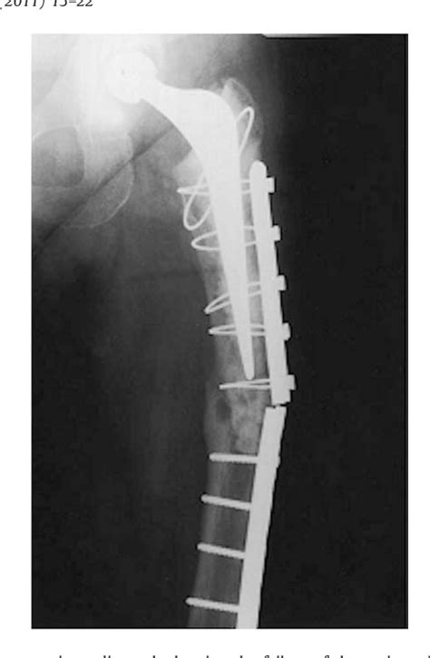 Figure 1 From Periprosthetic Fracture Fixation Of The Femur Following