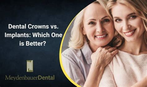 Dental Implants Vs Crowns Choosing In Bellevue