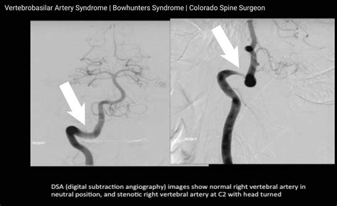 Vertebrobasilar Artery Syndrome Axial Rotation Artery Compression