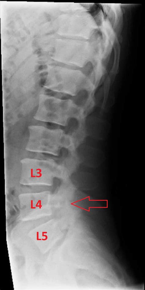 Lumbar Spine X Ray Labeled