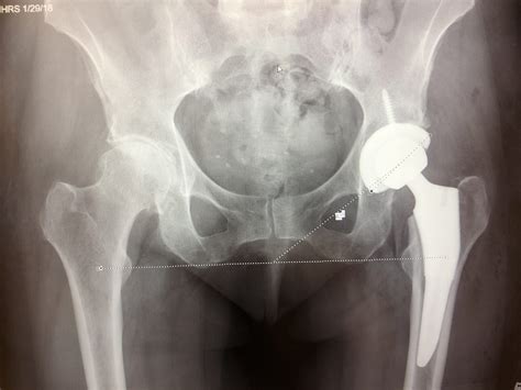 Anterior Hip Replacement Surgery An Overview Osms Orthopedic And Rheumatology Services In