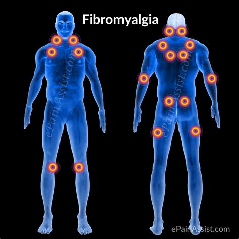 Faq On Fibromyalgia Symptoms 11 Painful Trigger Points Causes Risk Factors