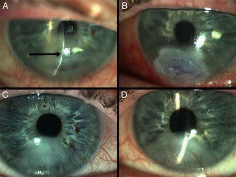 Xerophthalmia And Keratomalacia Secondary To Diet Induced Vitamin A