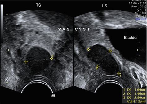 Ultrasound Evaluation Of The Vagina Obgyn Key