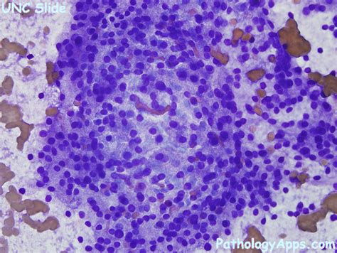 Acinic Cell Carcinoma Salivary Gland Cytology