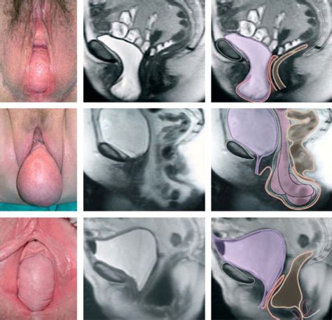 Pelvic Organ Prolapse The Lancet