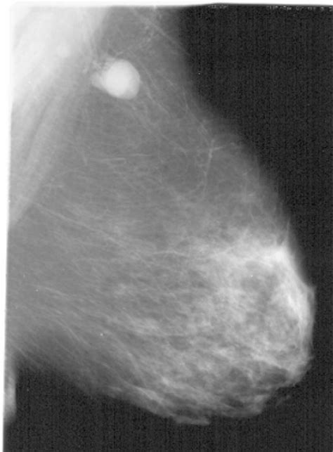 Title Mammogram From Case 1 Data Description Mammogr Open I