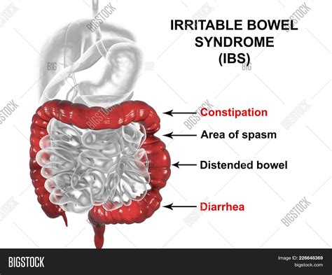 Irritable Bowel Syndrome Ibs Medical Concept 3d Illustration Showing Spasms And Distortion Of