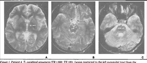 Figure 1 From Mri Detects Cerebral Involvement In Neurologically