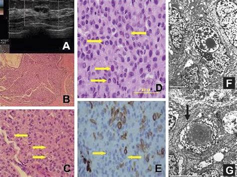 Intranuclear Inclusions In Epithelial Cells Of Benign Proliferative