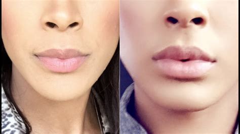 Juvederm Lips Before After Pictures Lipstutorial Org