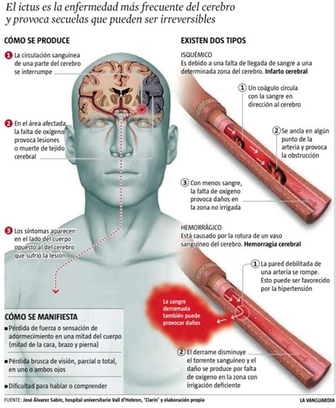 Los Accidentes Cerebrovasculares Ictus Y Derrame Cerebral I