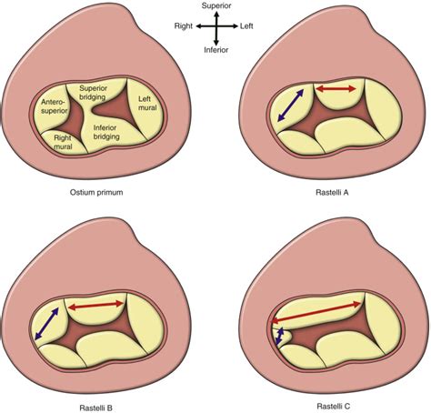 Atrioventricular Septal Defects Thoracic Key