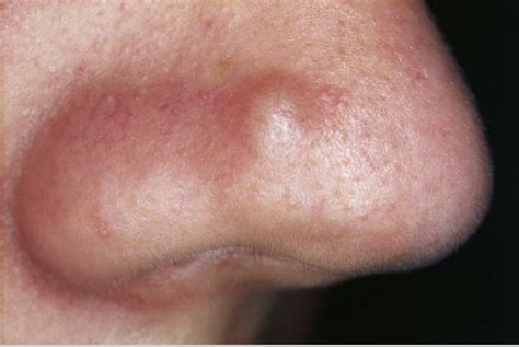 Dermatological Conditions Of The Nose Dermatology Games