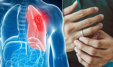 Lung Cancer Symptoms Signs Of A Tumour Include A Cough And Fingertip