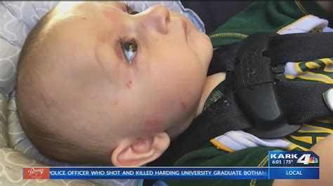 Baby Bitten Multiple Times At Sherwood Daycare Youtube