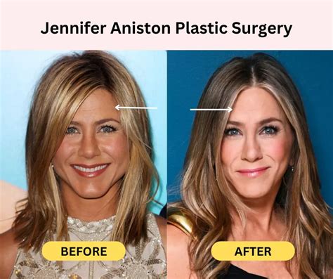 Jennifer Aniston Plastic Surgery Secrets Before And After Photos Fabbon