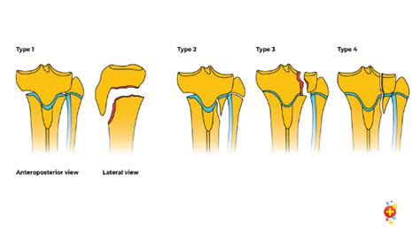 Proximal Tibial Fractures Dont Forget The Bubbles