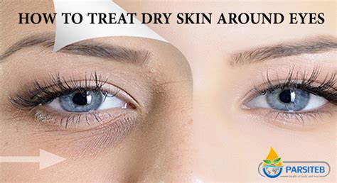 How To Treat Dry Skin Around Eyes Parsi Teb