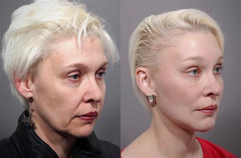 Mini Facelift Before And After Dr Andrew Jacono Eye Lift Surgery Face Lift Surgery Mini