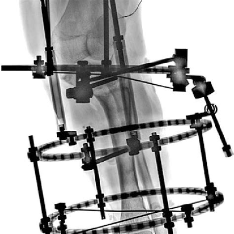 Ap And Lat Radiographs Of The Left Tibia At The End Of Consolidation