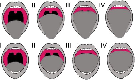 utility of the modified mallampati grade and friedman tongue position in the assessment of