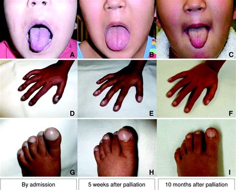 Rapid Regression Of Classic Clinical Signs Of Cyanosis Accompanied By
