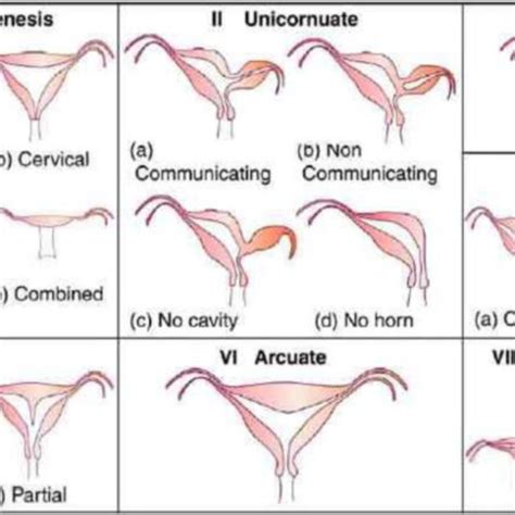 Eshre Esge Main Classes Subclasses And Coexistent Cervical Vaginal
