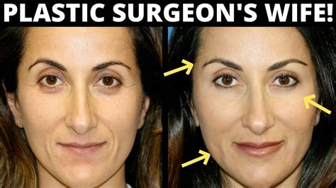 Facial Fat Transfer Before And After Look 10 Years Younger With Facial