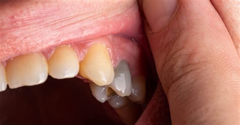 Martwy ząb przyczyny objawy rozpoznanie leczenie profilaktyka