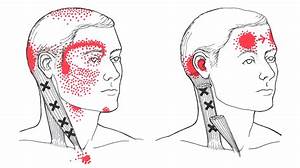 Sternocleidomastoid The Trigger Point Referred Guide