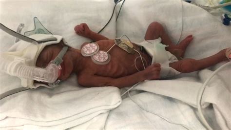 Miracle Baby Smallest Child Ever Born At Nassau University Medical