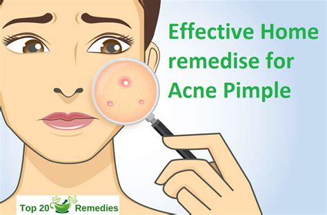 How To Get Rid Of Pimples Permanently Using Home Remedies How To Get