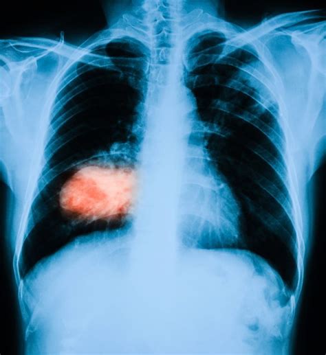 Tumor In Lungenkrebs Patient Schrumpft Nach Vier Monaten Behandlung Mit