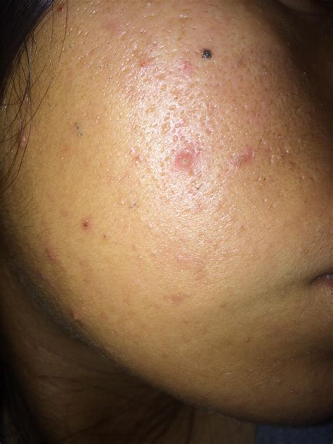 Oily Skin And Stubborn Bumps On Face Oily Skin Forum