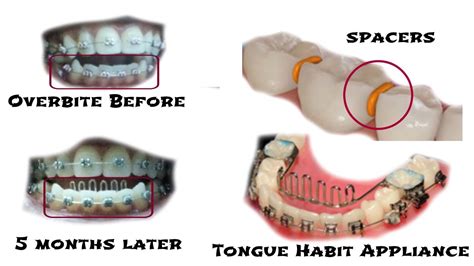 Braces Update 5 Months Overbite Rubberbands Tongue Habit