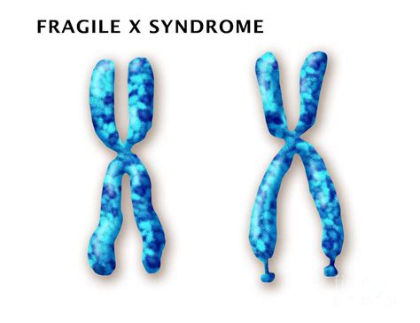 Fragile X Syndrome Causes Symptoms Diagnosis And Treatment Online Biology Notes